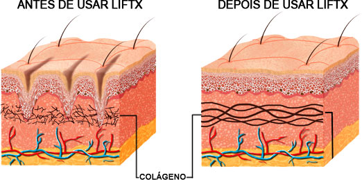 antes depois lift x