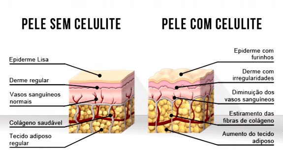 graus da celulite