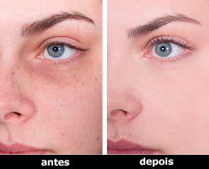 antes e depois