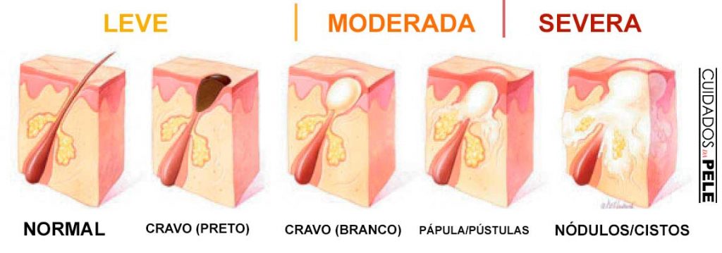 tipos de espinhas e cravos