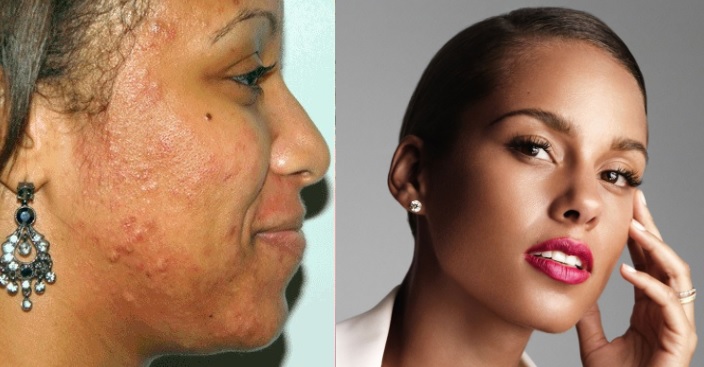 alicia keys acne